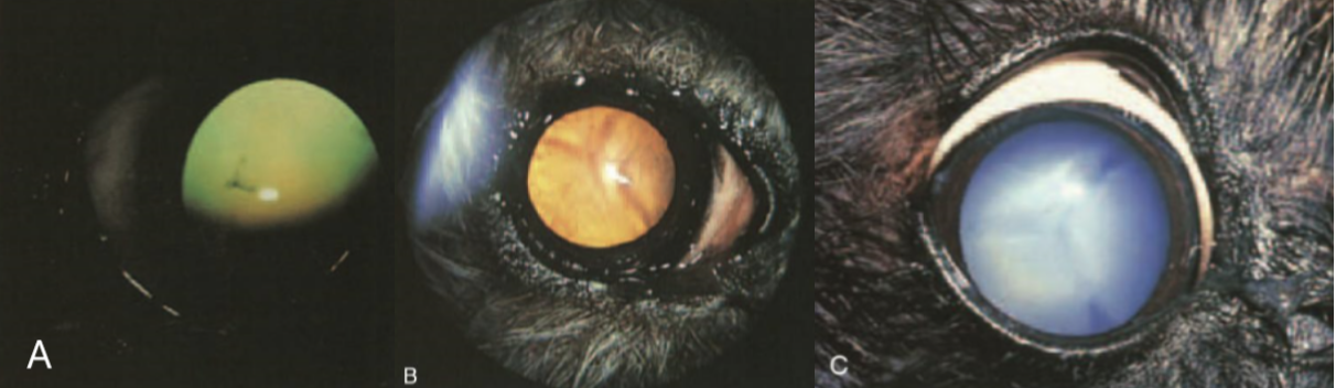cataract figures